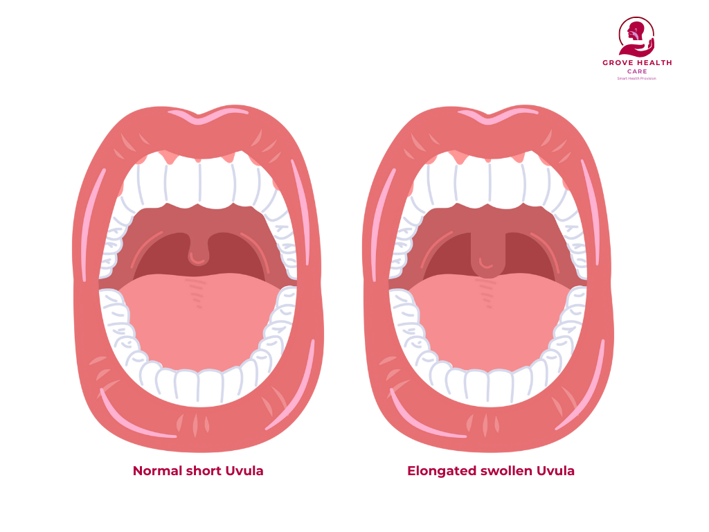 ELONGATED UVULA