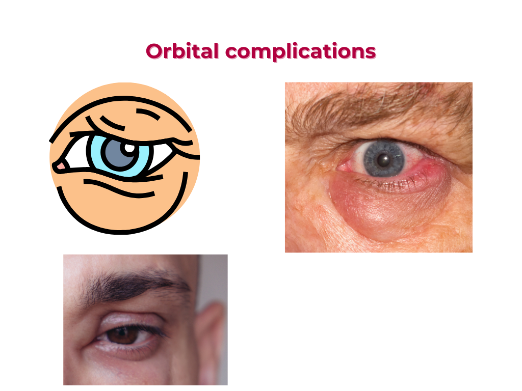 Orbital complications