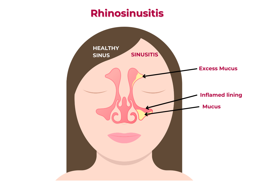 Rhinosinusitis
