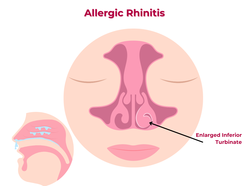 GHC Rhinitis
