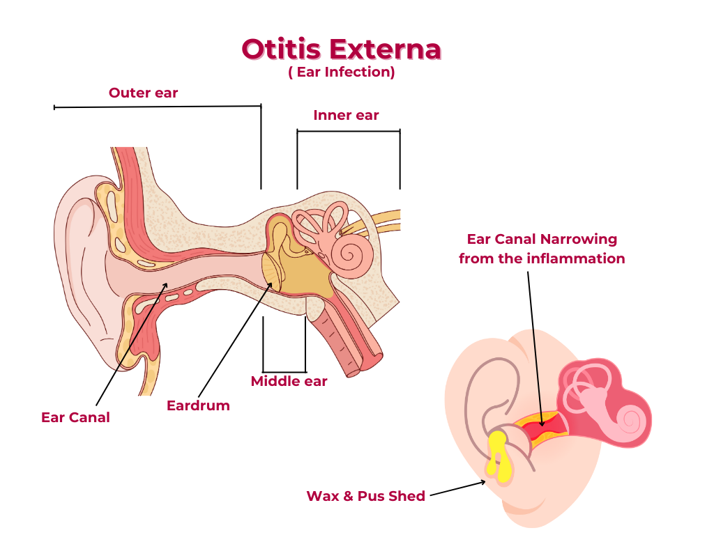 Otitis Externa
