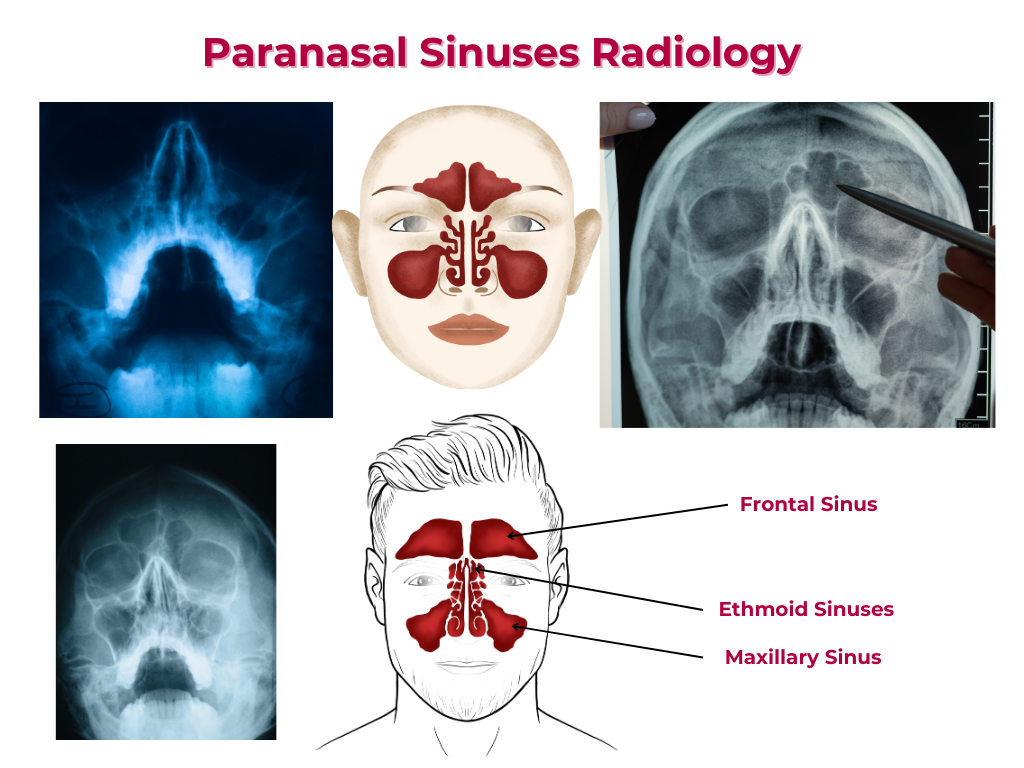 paranasal sinuses radiology