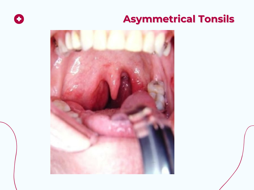 Asymmetrical Tonsils