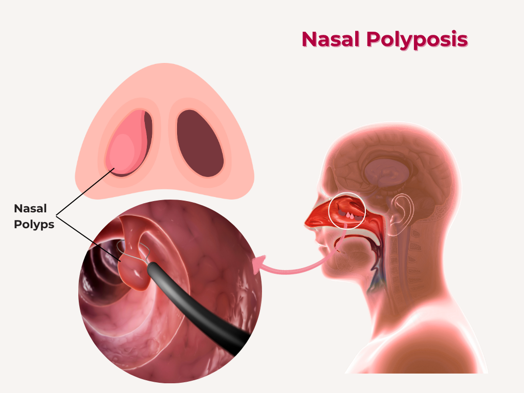 Nasal Polyposis