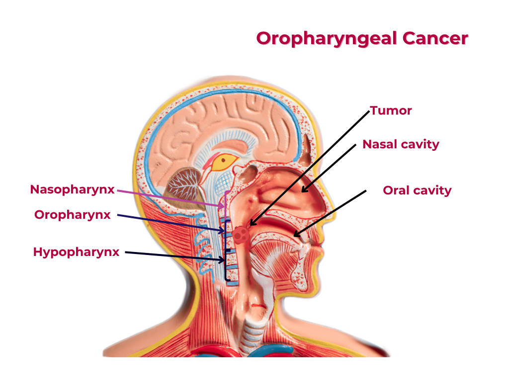Oropharynx Carcinoma