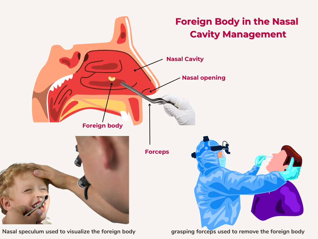 Forign Body in Nasal
