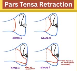 Sade Classification of Oars Tensa Retraction