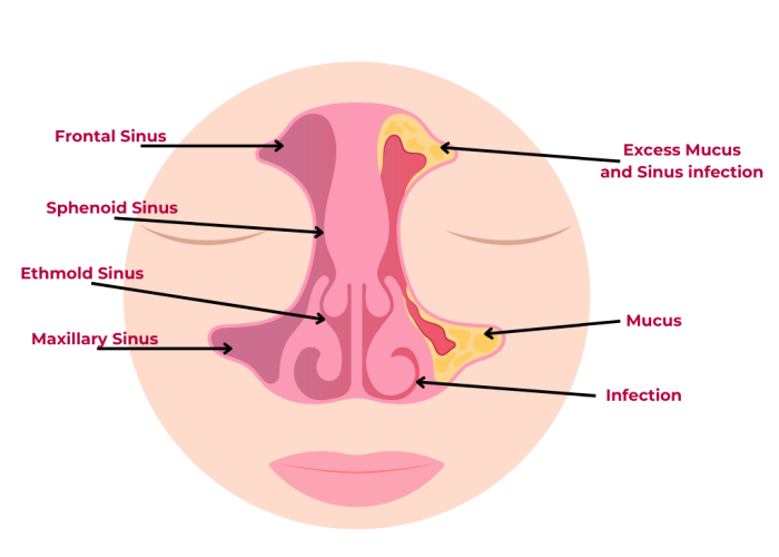 sinusitis 1 sinusitis 1
